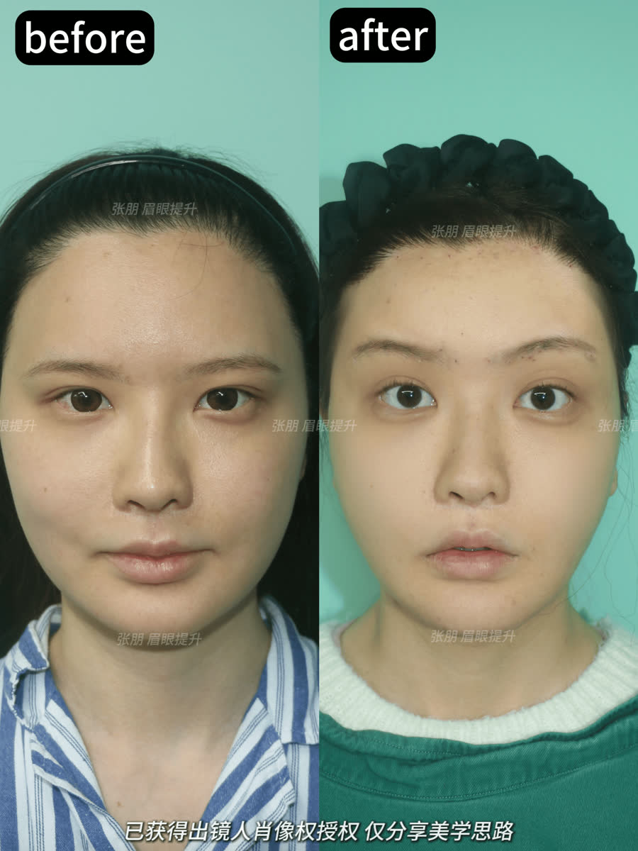 内窥镜眉眼提升前后对比授权案例