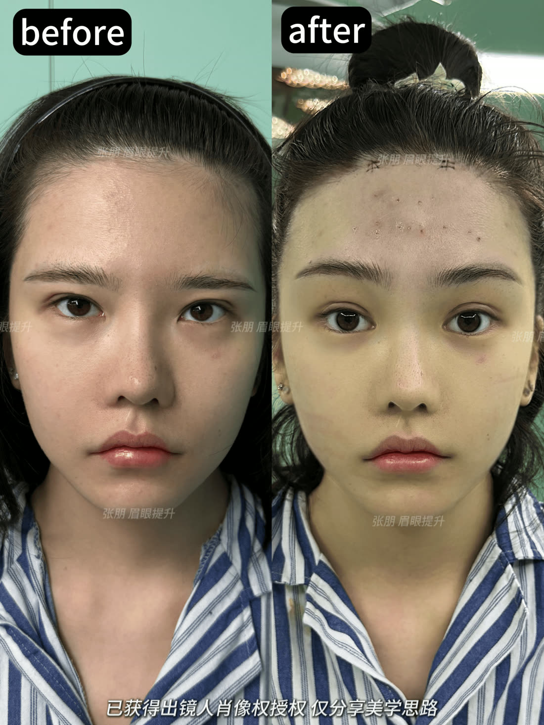 内窥镜眉眼提升授权案例前后参考四