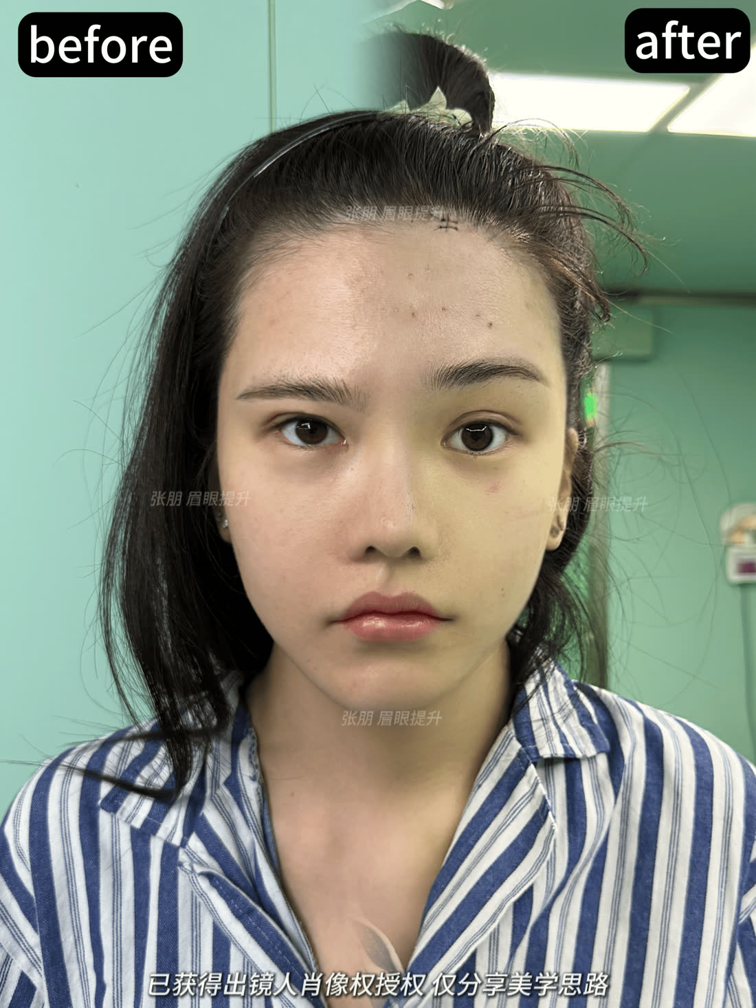 内窥镜眉眼提升授权案例单图参考四
