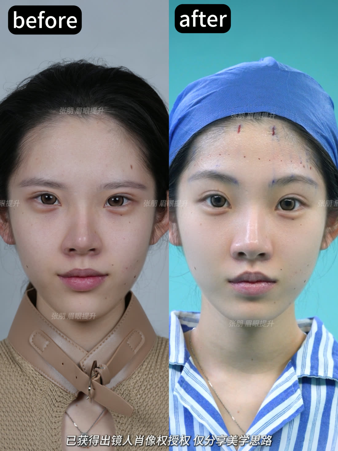 内窥镜眉眼提升前后对比授权案例五
