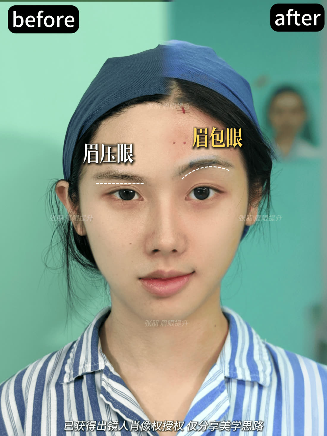 眉压眼与眉包眼问题标注授权案例