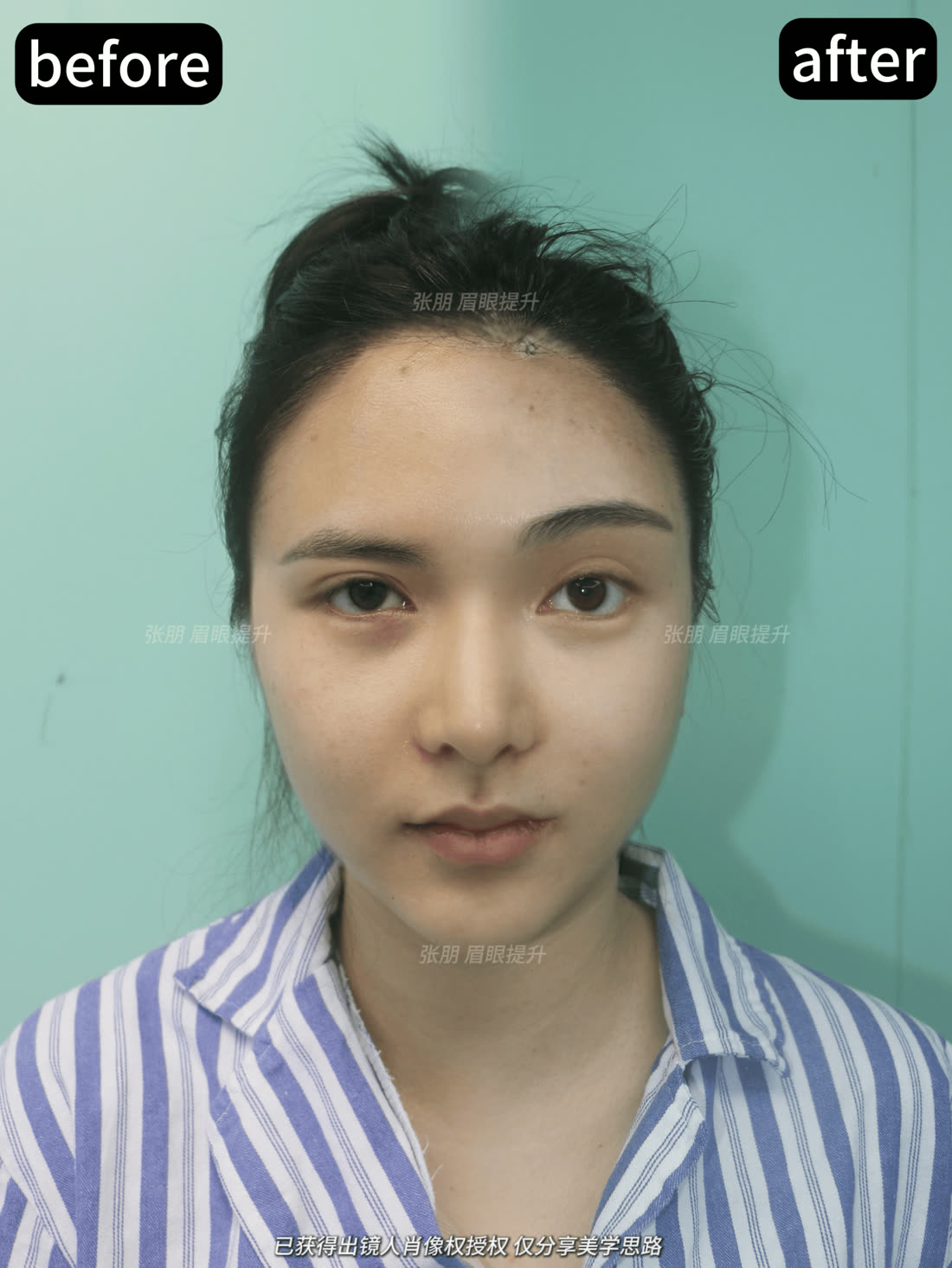 内窥镜眉眼提升授权案例单图参考八