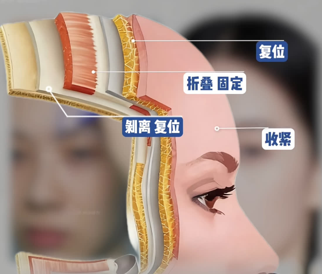 额头7V回春术结构复位示意图
